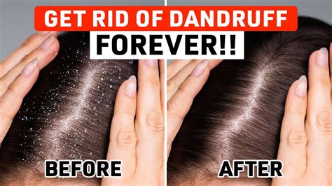 are dandruff remedies fake